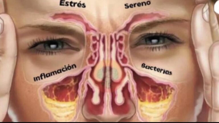 ACABA CON LA SINUSITIS